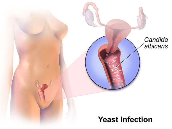 Yeast infections