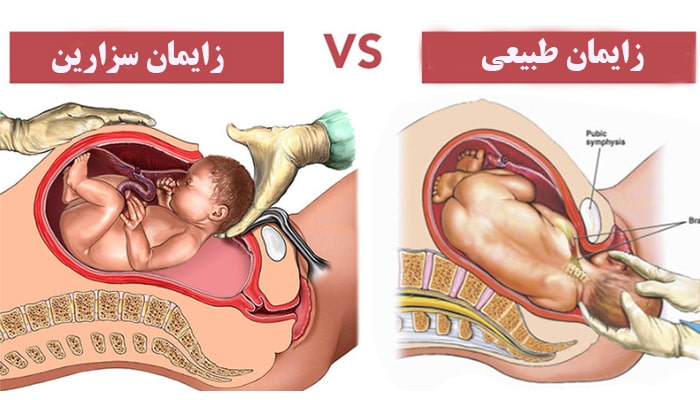 تفاوت زایمان طبیعی و سزارین