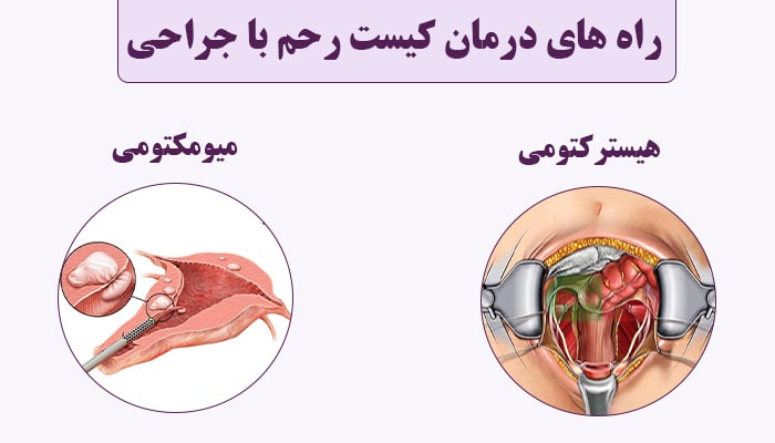 درمان سریع کیست رحم