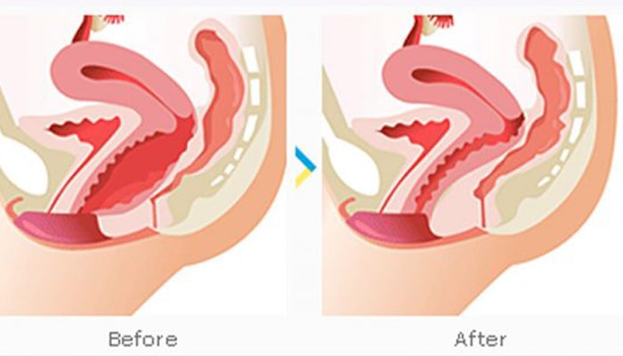 عمل زیبایی واژن بعد از زایمان