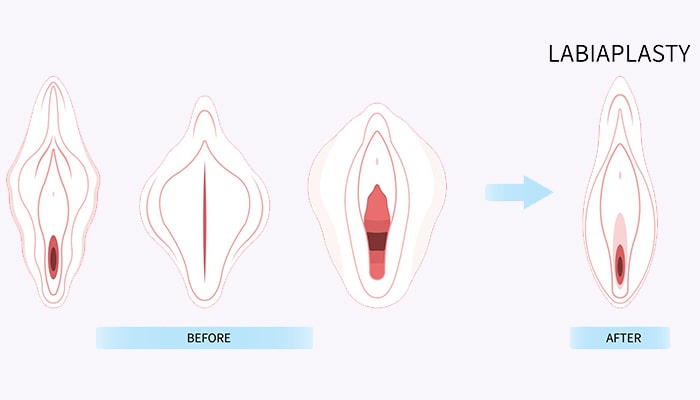 انواع عمل زیبایی واژن بعد از زایمان