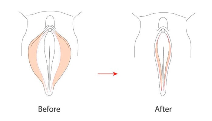 کاربرد عمل زیبایی واژن بعد از زایمان