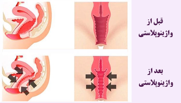 واژینئپلاستی برای درمان خروج باد از واژن