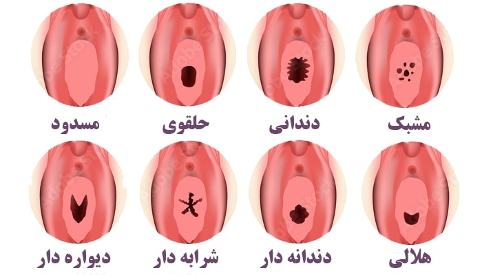 انواع پرده بکارت