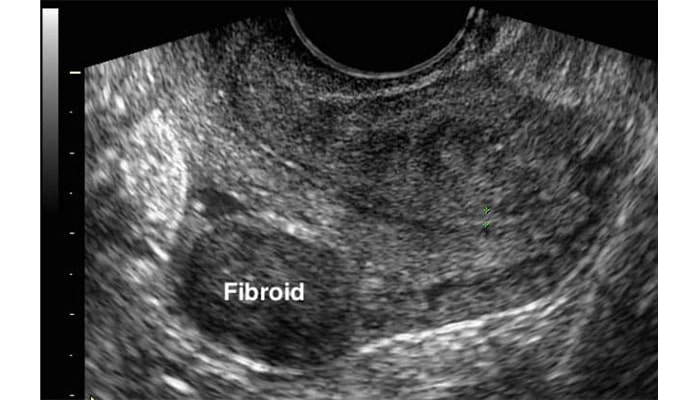 عکس فیبروم رحم در سونوگرافی