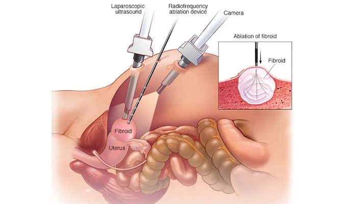 عمل جراحی برای درمان فیبروم رحم