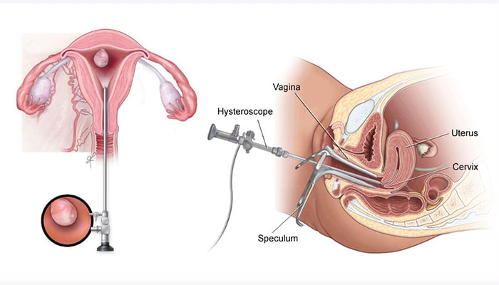 نحوه انجام هیستروسکوپی