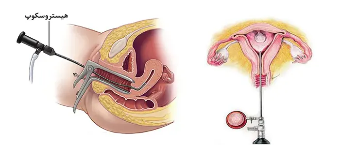 درمان نازایی با هیستروسکوپی