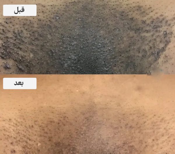 ناحیه تناسلی زنان چرا سیاه میشود؟