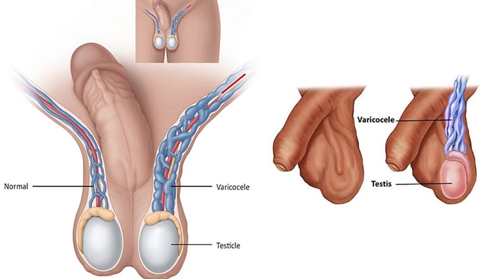 آیا واریکوسل بعث نابروری می شود 