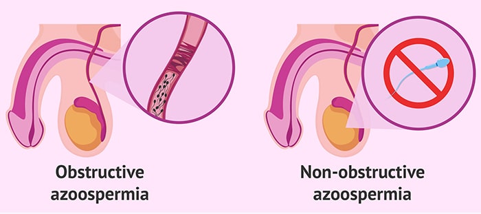 انواع آزواسپرمی کدامند