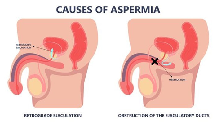 آزواسپرمی به چه علت ایجاد می شود