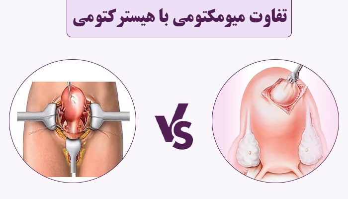 آیا  میومکتومی با هیسترکتومی متفاوت است ؟