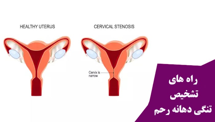 راه های تشخیص تنگی دهانه رحم