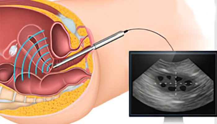 سونوگرافی ترانس واژینال چیست