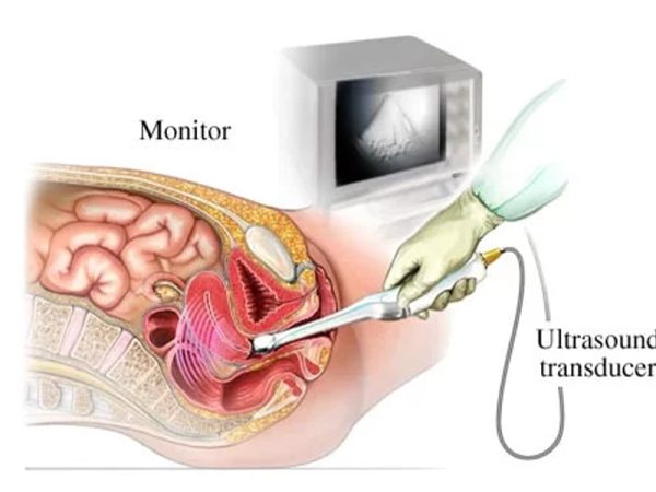 سونوگرافی ترانس واژینال
