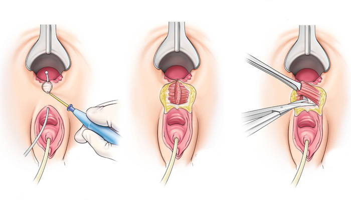 عمل جراحی فیستول واژن