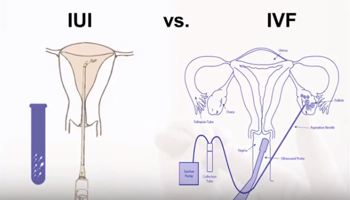 آیا IUI بهتر از IVF است؟