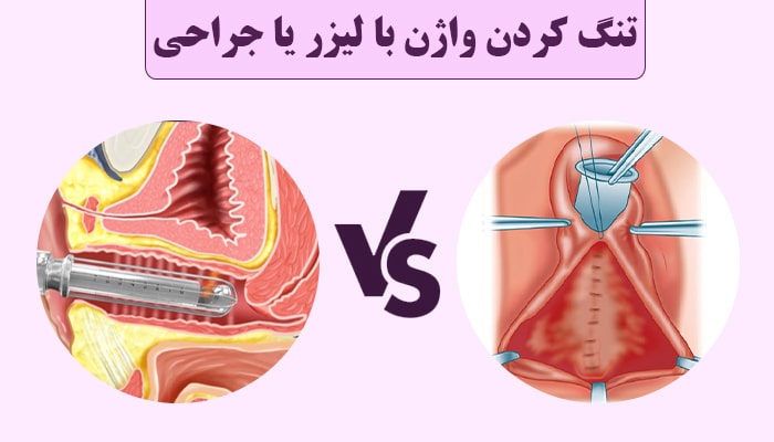 تنگ کردن واژن با لیزر بهتر است یا جراحی