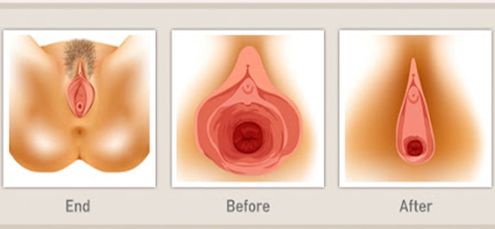 واژینوپلاستی با لیزر چگونه انجام می شود؟