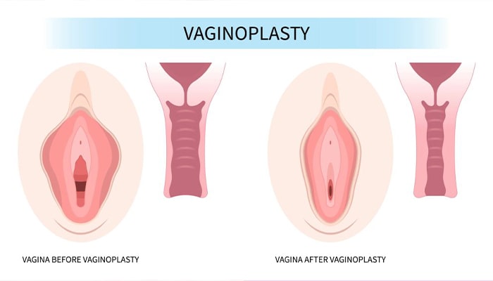 مزایای واژینوپلاستی با لیزر نسبت به روش جراحی