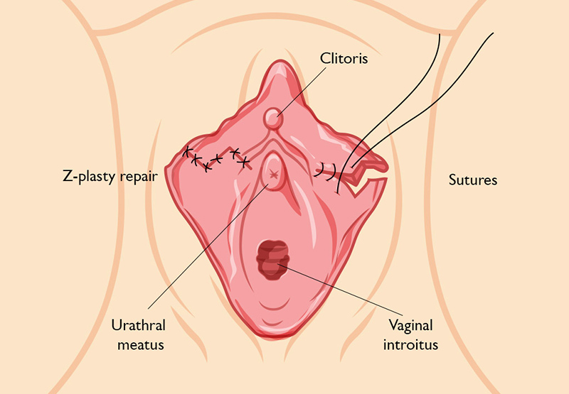 علائم بهبودی بخیه های واژن بعد از لابیاپلاستی