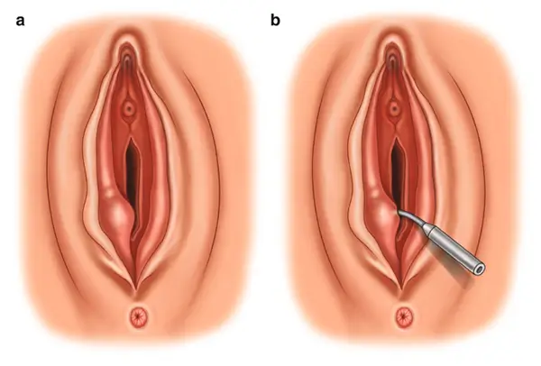 عکس توده سفت زیر پوست در ناحیه تناسلی زنان