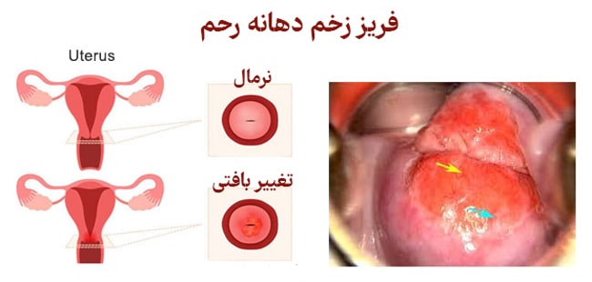 مراقبت های بعد از فریز زخم دهانه رحم
