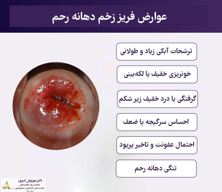 مراقبت های بعد از فریز زخم دهانه رحم