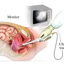 سونوگرافی ترانس واژینال