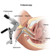 کولپوسکوپی