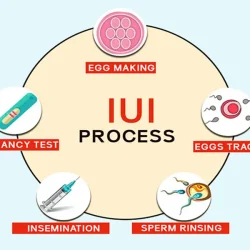 درمان ناباروری به روش IUI